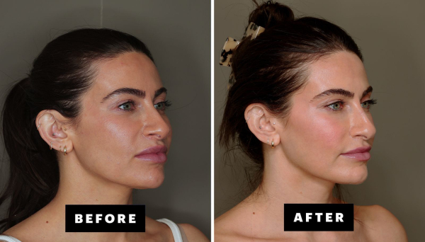 before and after images of facial grafting under the eyes and in the temples on a woman. her hair is pulled back the...